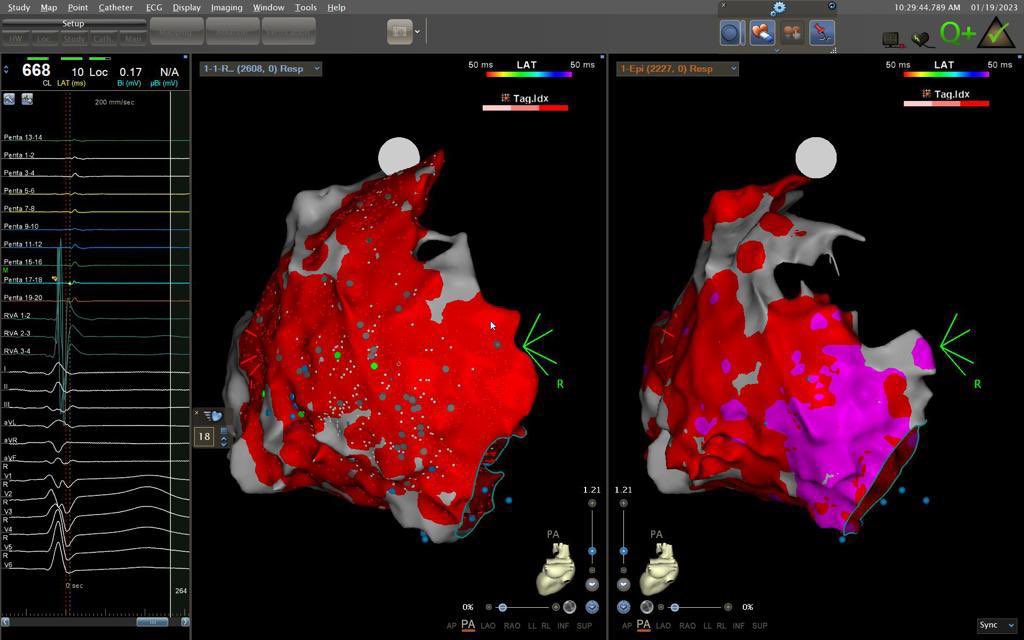 First epicardial focal PFA VT ablation with complete clean out of late potentials in a post-myocarditis VT pat in our center. See LP map before on the right and after PFA in the middle. Very interesting tech for epi ablation!?