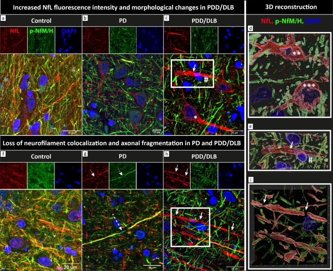 NeuroLaura's tweet photo. Publication online! 🚨 On the regional distribution of neurofilament light in the human brain and it's association with pathological hallmarks and neuroimaging measures in PD and PDD. Great work by @FrigerioIrene &amp; co!

https://t.co/V5PrG9uYAG https://t.co/gJhuqqkQZe