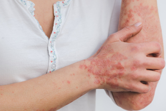 Europso_org's tweet photo. Did you know that Europe has the highest prevalence of psoriatic disease globally, with an estimated 6.4 million people living with psoriasis? #psoriasis #cleanskingoals #EUROPSO #IFPA #morethanascratch https://t.co/vdxXEvnlct