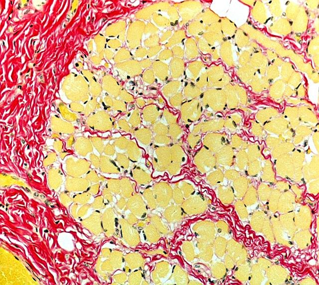 ukneqascpt's tweet photo. This HVG slide from the Specialist Techniques Scheme, seen at 20x magnification scored 10/10.
The red collagen and yellow muscle from the Van Gieson stain are well demarcated with good staining of the blue/back nuclei.
An excellent example!
#cellpath https://t.co/dMz317QRm5