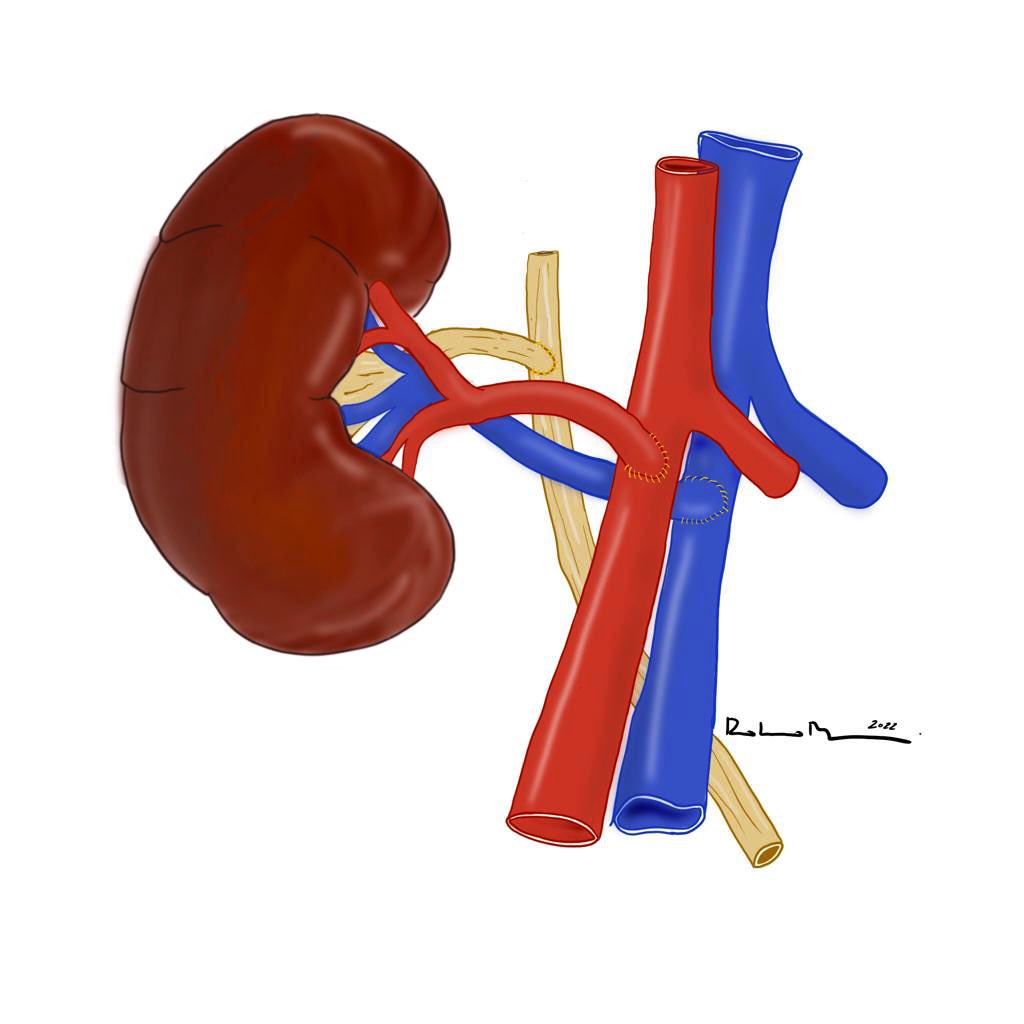 BatistaTP's tweet photo. Interesting technical note on ultrashort anisoperistaltic end-to-side ureteroureterostomy in renal transplantation, at #RCBC by @CBCcirurgioes, via @RedeSciELO. 🖇 https://t.co/je3ceBMRAT @nkf @KidneyFund @KidneyTranspla4 @ASNKidney @AST_info @TransplantJrnl @amjtransplant https://t.co/8C4RxA6raZ