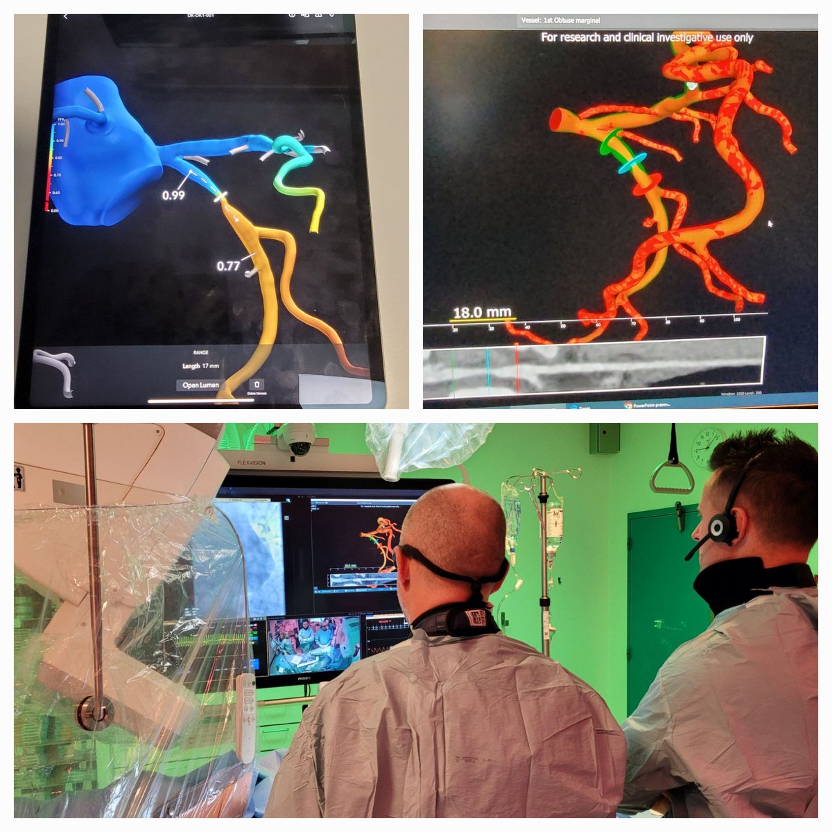 Exciting week for interventional cardiology @AUHCardio. First patient included in the “Precise Procedural and PCI Plan (P4) study”. Great backup from PI @ColletCarlos and @CoreAalst
Huge potential #CTguidedPCI and the future in treatment of  #CAD. @MichaelMaeng1 #RadialFirst