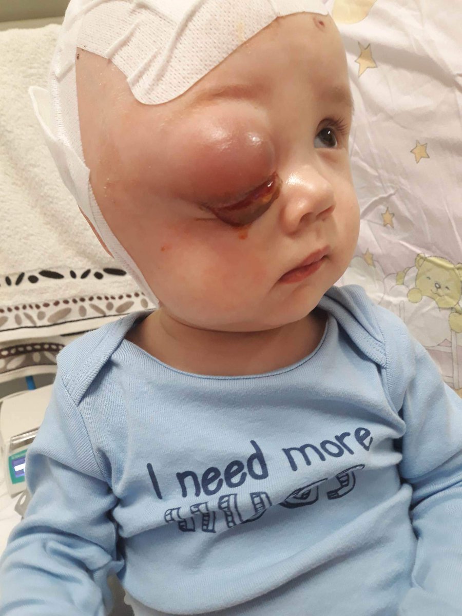 #Alert ‼️Zatrzymaj się na chwilę. 
Ja już nie wiem jak prosić, ja już błagam o pomoc. Za oczkiem i w mózgu jest ogromny złośliwy guz! Jedyna szansa dla Szymonka jest w klinice w Niemczech. Brakuje 2,5 mln zł. Pomóżcie👇 siepomaga.pl/szymek-owczarek