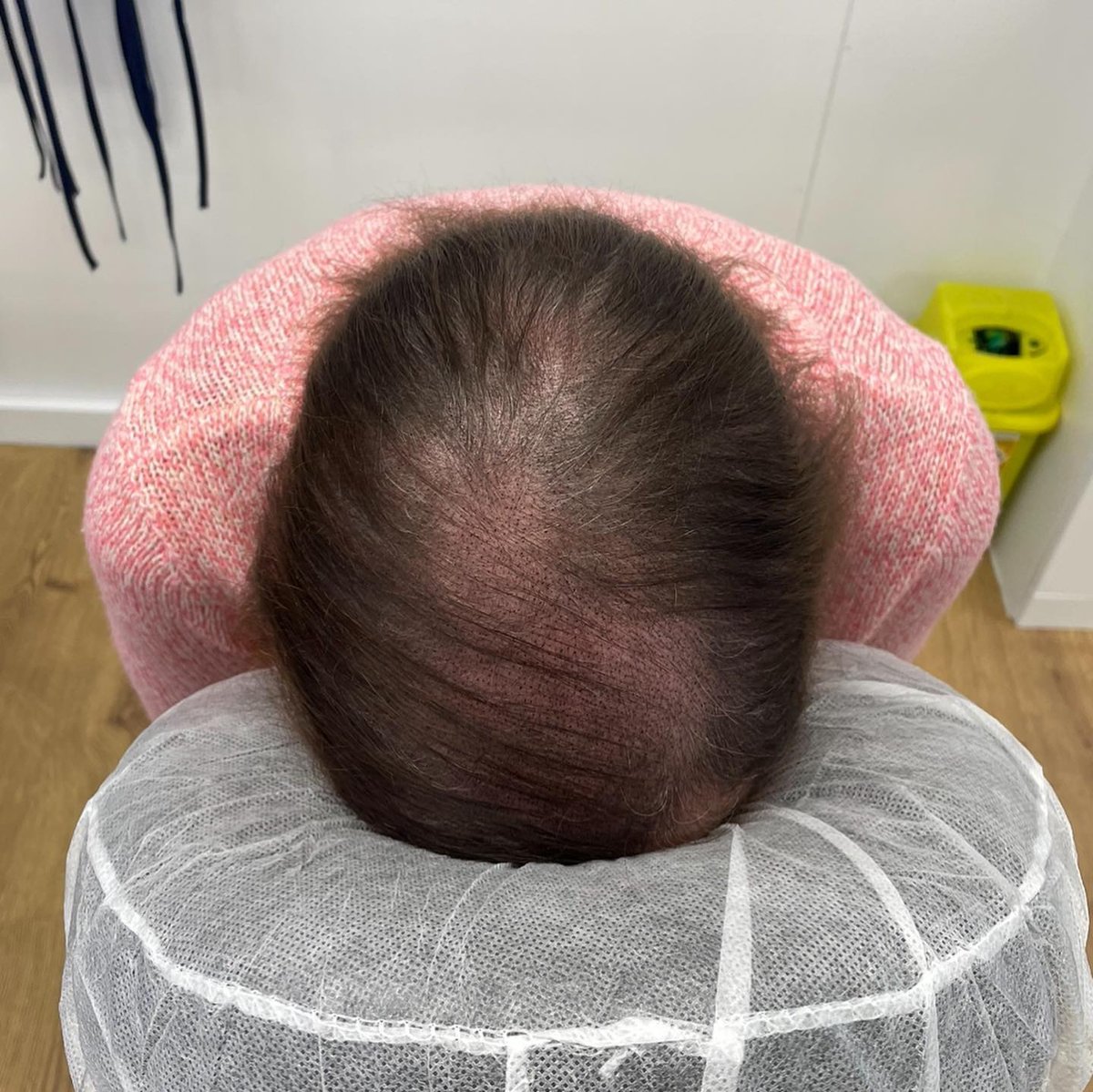 pollard_yard's tweet image. Scalp micropigmentation doesn&apos;t have to be exclusively for men you know? Our tenant @MicromagicC are keen to work with anyone experiencing hair loss. Check out this incredible density fill; giving the appearance of a thicker and fuller head of hair.
#micropigmentation