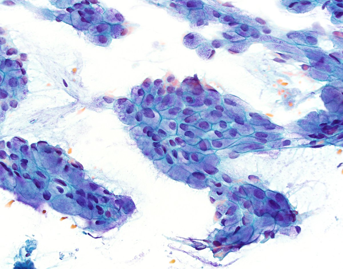 Happy FNA Friday! This is an FNA of a pancreatic head mass. What is your diagnosis? #cytology #GIPath #pathology 1/