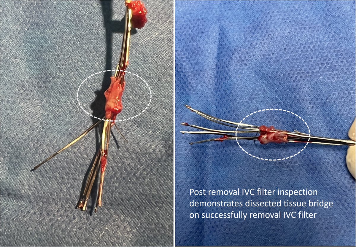 First #FilterOUTFriday of 2023! Tip embedded, fractured Option IVC filter placed at OSH with multiple legs traversing R renal vein. Thank you for your service, Mr. IVC filter Forceps for the win 🐊 #IRad #ForcepsFriday @UTSW_VIR @UTSW_RadRes @SIR_ECS