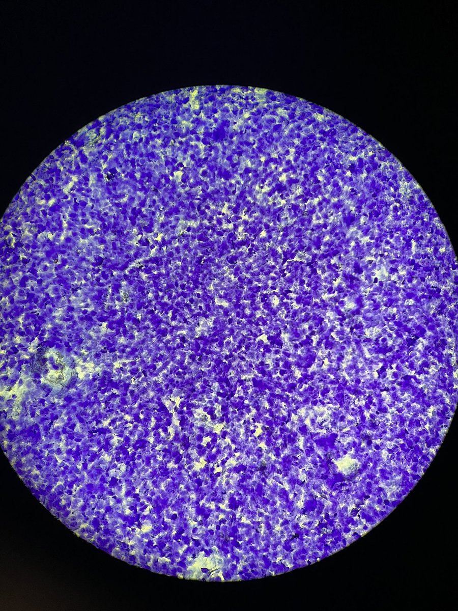 lystsvn's tweet photo. an epithelial garden at the lab today (sparser areas were subsequently used for pictures)
#crystalviolet #cytology https://t.co/6Vlsnd61nD