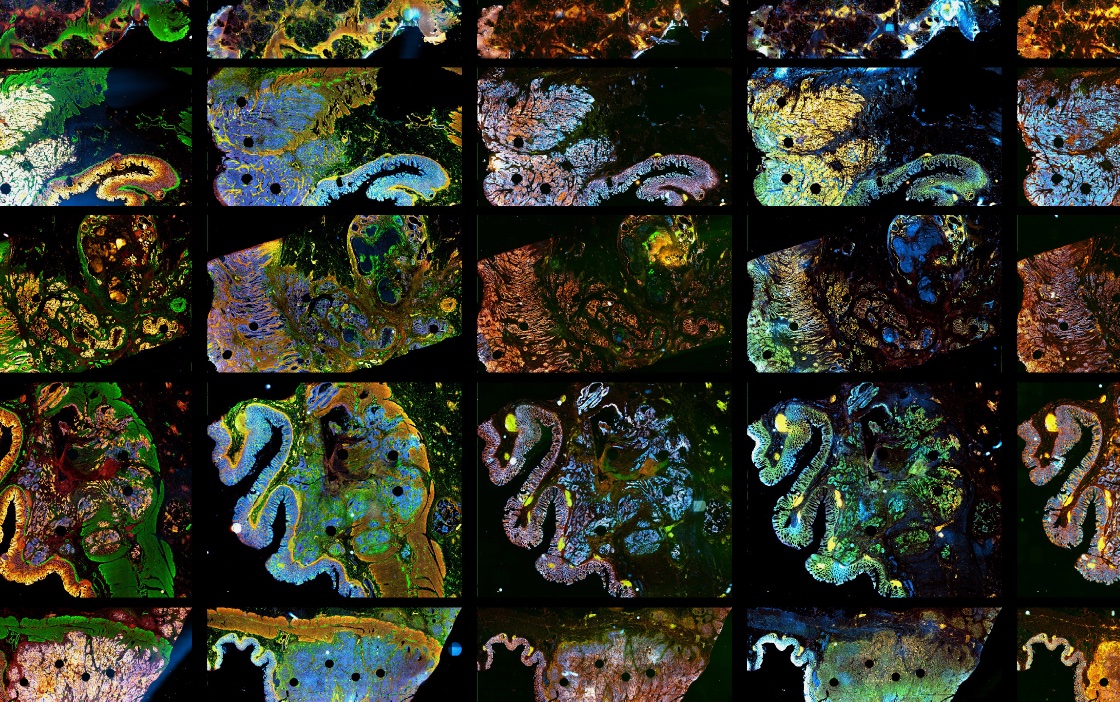 Harvard_Lab's tweet photo. Excited to announce the Harvard Colorectal Cancer Atlas! 

Our team examined >18 colorectal cancer samples, revealing new insights into immune interactions, morphological and molecular gradients, and 3D interconnected structures within CRC tumors! 

https://t.co/8uYYkf8NQH https://t.co/mttra3iEHJ