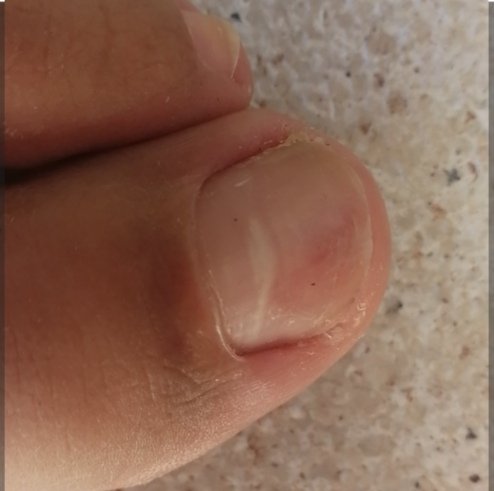 Cenamor's tweet photo. Alguien sabe que le pasa a esta uña? , no duele ni pica ni nada. 🤔. Algún Experting que quiera divagar??? https://t.co/0VNWXGLF2Y