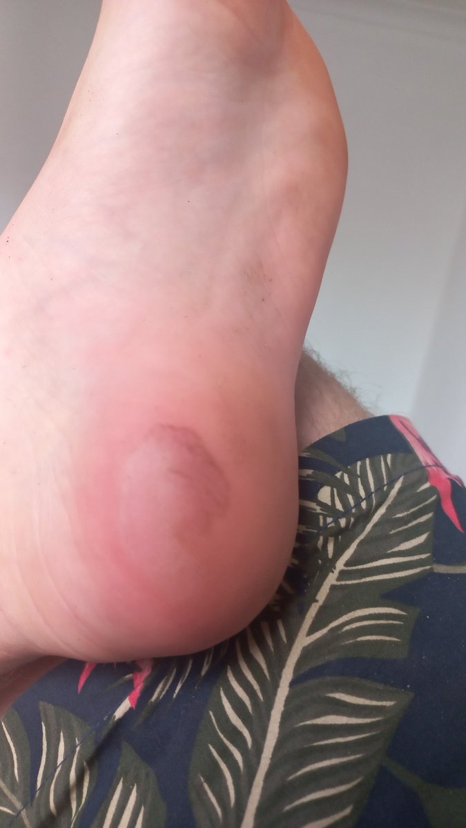 NotanuBlisss's tweet photo. @feetographyace I have some exposed skin on my foot do you have any remedies for it https://t.co/3naFDZCO3z