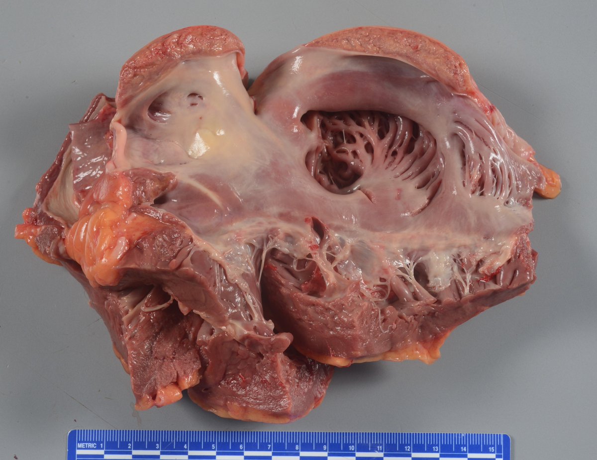 theNAME1966's tweet photo. Case of the Week: The case involved a 53-year-old woman who was found unresponsive at home.  What’s going on in her heart?
https://t.co/zcWf1eZi9r https://t.co/iE6tJLEKIQ
