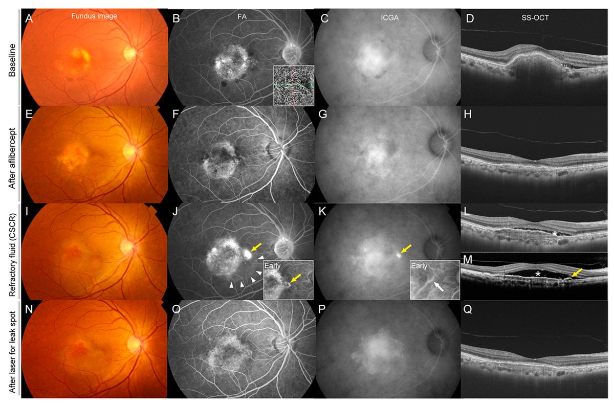 Pharmaceut_MDPI's tweet image. 📢 Have you checked out  #recentlypublished article:

📖 Title: #Refractory Age-related #Macular Degeneration Due to Concurrent Central Serous #Chorioretinopathy in Previously Well-Controlled #Eyes

👉 mdpi.com/1424-8247/16/1…