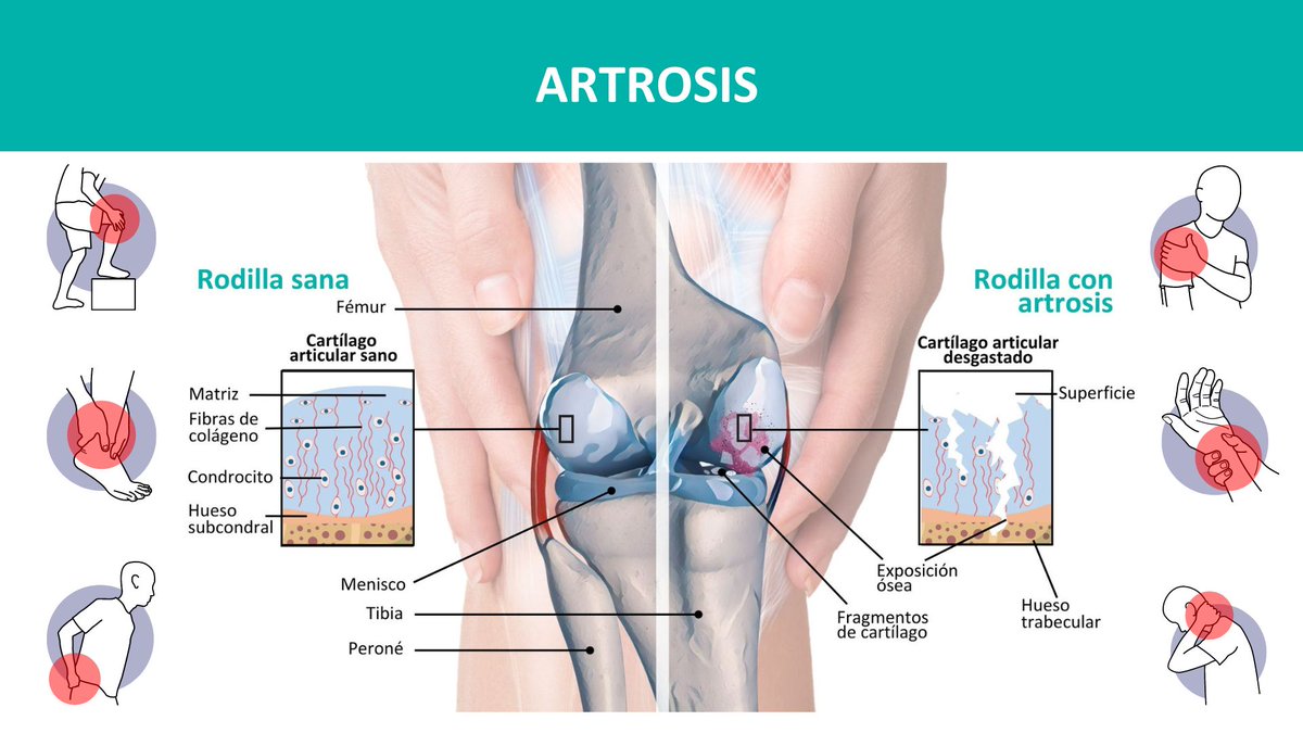 Dr_Maizo's tweet photo. ¿Sabías que la artrosis es la forma más común de artritis? También se llama artritis degenerativa. Es la enfermedad reumática más frecuente en el mundo. Afecta a más de 350 millones de personas 🌍. Acude a tu traumatólogo. #artritis #salud #artrosis #drmaizo https://t.co/jhJvsm9PRY