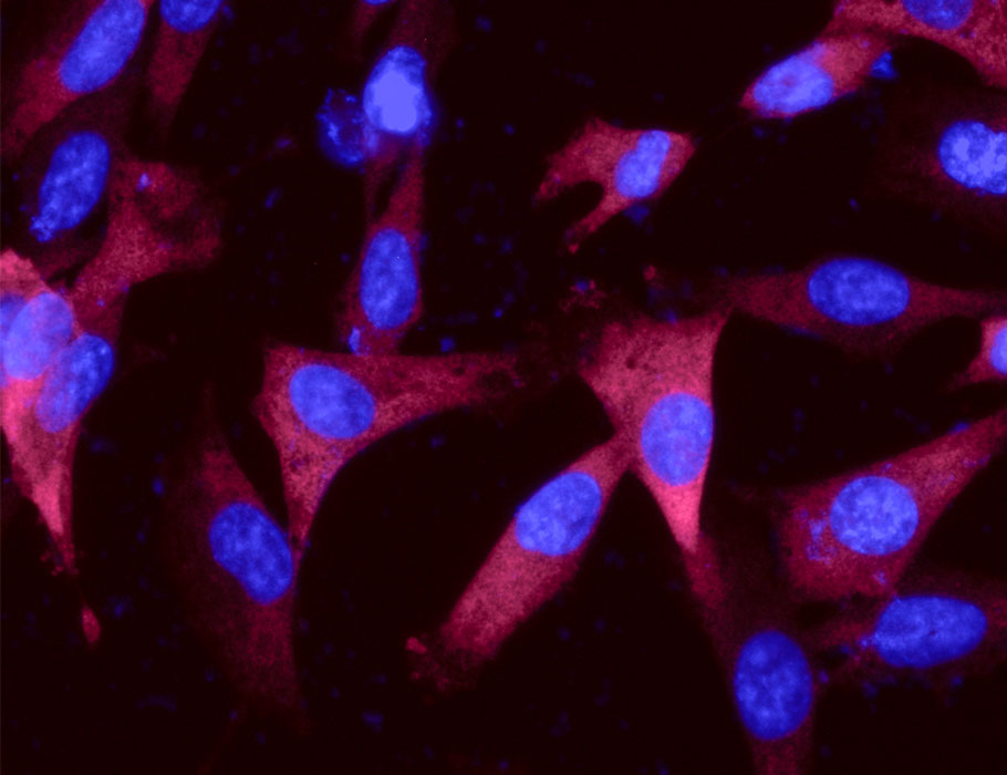 Science Translational Medicine (@sciencetm) on Twitter photo A compound that targets de novo lipid synthesis in #GliomaStemCells shrinks #glioblastoma tumors in mice, potentiates DNA-damaging agents, and can penetrate the blood-brain barrier.
Read more: scim.ag/1eG <a href="/katharinaeyme/">Katharina Eyme</a> <a href="/BadRlab/">BADRlab</a> <a href="/ale_samma/">Alessio Sammarco</a> A compound that targets de novo lipid synthesis in #GliomaStemCells shrinks #glioblastoma tumors in mice, potentiates DNA-damaging agents, and can penetrate the blood-brain barrier.
Read more: scim.ag/1eG <a href="/katharinaeyme/">Katharina Eyme</a> <a href="/BadRlab/">BADRlab</a> <a href="/ale_samma/">Alessio Sammarco</a>