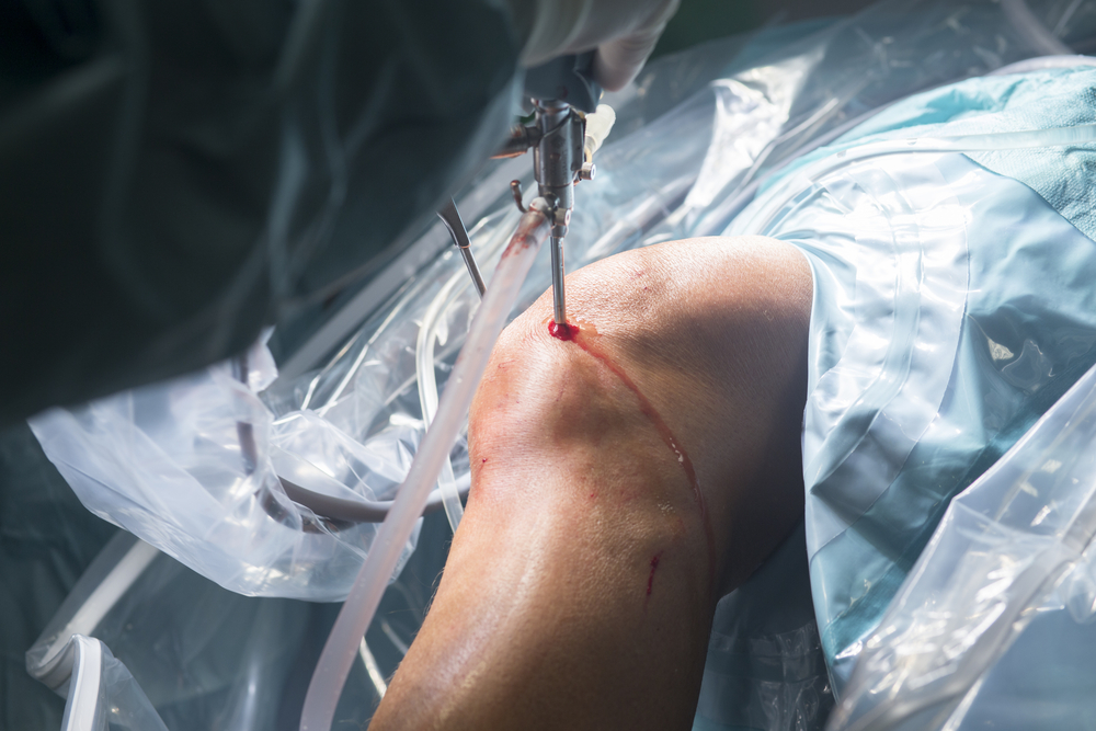 LASportsOrthoMD's tweet photo. Dr. Getelman offers a number of cartilage surgery procedures including #NeoCart, #chondroplasty, #Microfracture, fetal #cartilagerestoration, #osteochondral #autograft transfer, and osteochondral #allograft transplantation. Learn more about each option: https://t.co/aVhu6TWONh https://t.co/r0VyF87wdl
