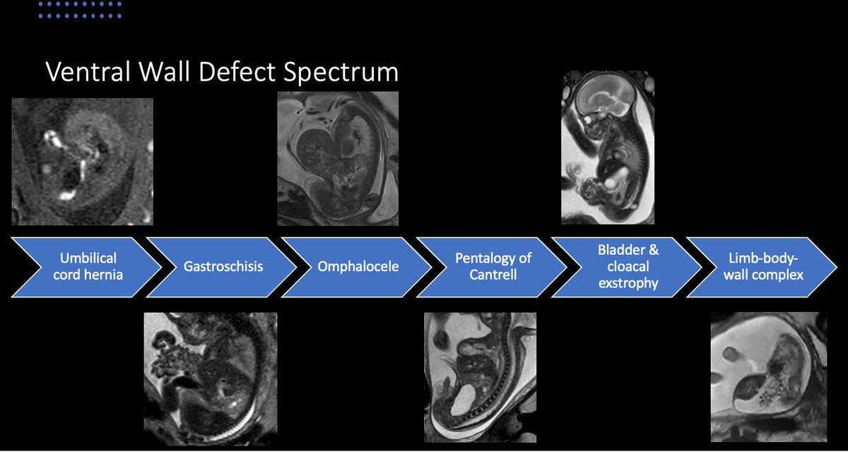 Excited to be a speaker amongst the fetal imaging giants and to provide an overview of ventral abdominal wall defects #SPRFetal2023