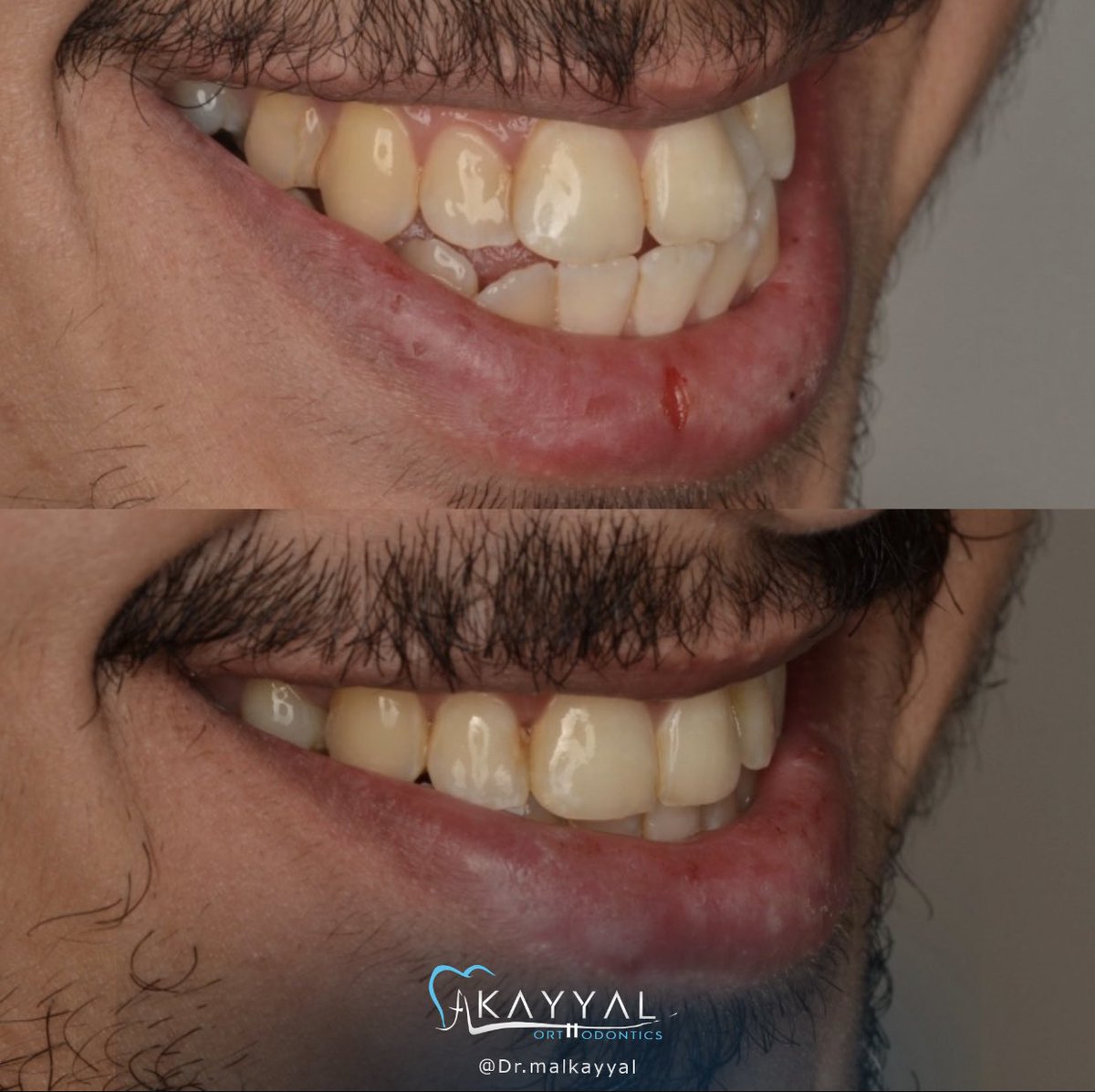 من بروز وازدحام وابتسامة مختلة 
.
إلى العكس تماما 😍
.
#د_مؤيد_كيال #جدة #استشاري #تقويم_الأسنان  #صحة #ابتسامة_صحية #orthodontist #orthodontics #jeddah #ladenta #عيادات_لادنتا_الاستشارية_لطب_الأسنان