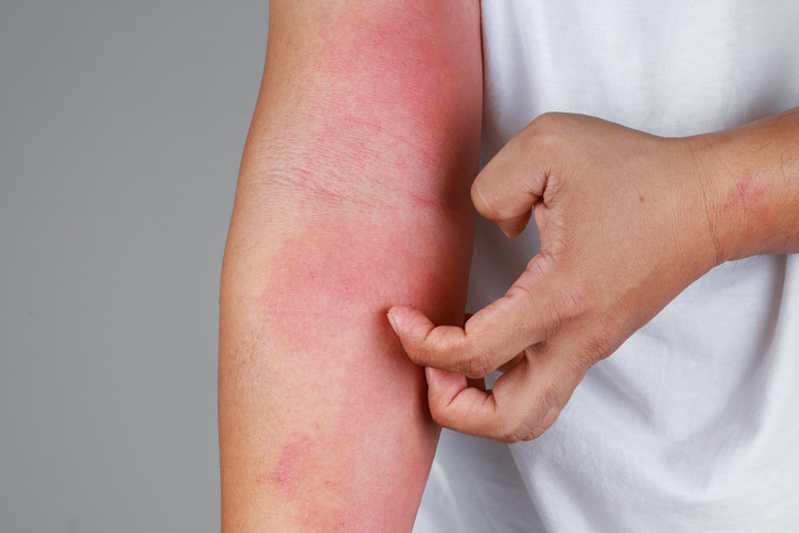 Simcoderm's tweet image. Adults aged 18 years or older with a diagnosis of atopic dermatitis for 12 months or more and a weight of 50 to 180 kg can apply for this clinical research trial. Eligible participants must have moderate to severe disease with plaques covering 10% or more of the body surface.