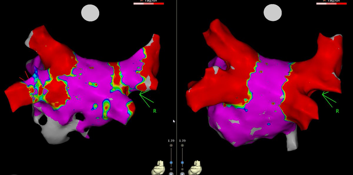 RDUH Electrophysiology Team tweet media