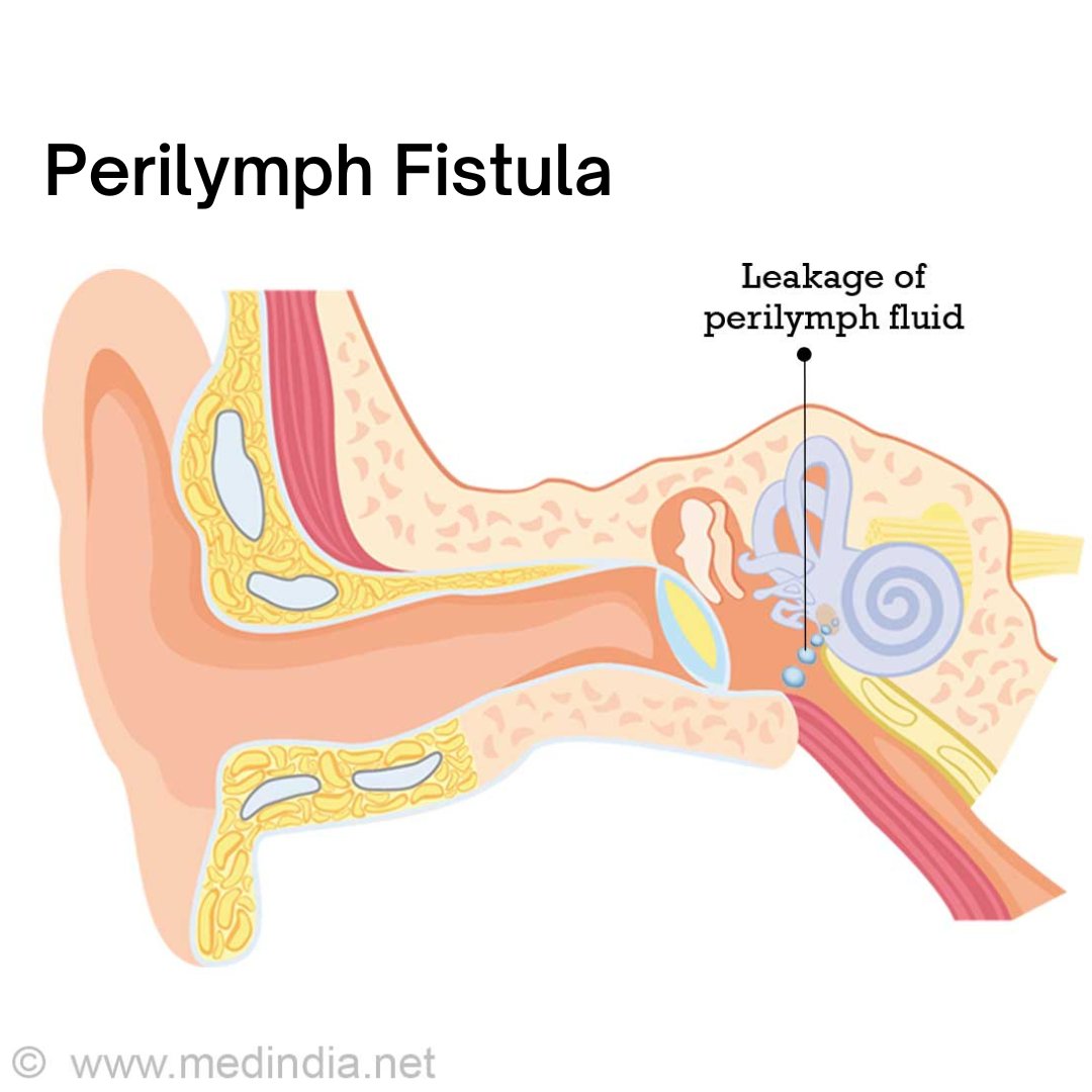 Perilymph fistula is a rare condition caused by an opening or tear in the membrane(s) separating the middle and inner ear. Causes balance and hearing symptoms that have common triggers.

balanceanddizziness.org/disorders/vest…

#dizziness #health #vertigo #physiotherapy #ENT