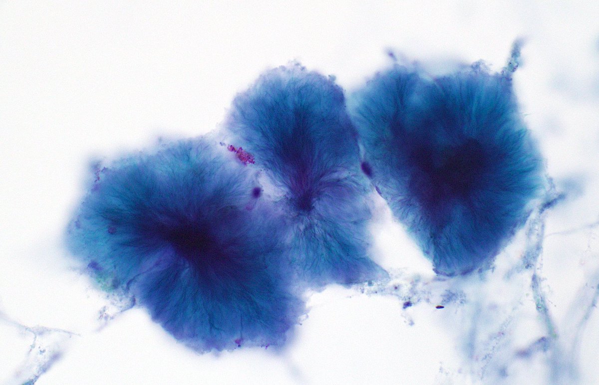 ArashLahouti's tweet photo. Interesting "iris" pattern of myxoid substance; from an aspirate of a pancreas mass with adenocarcinoma.  
#cytology #cytopathology #pathart #cytolove https://t.co/6WdLZJcSrR