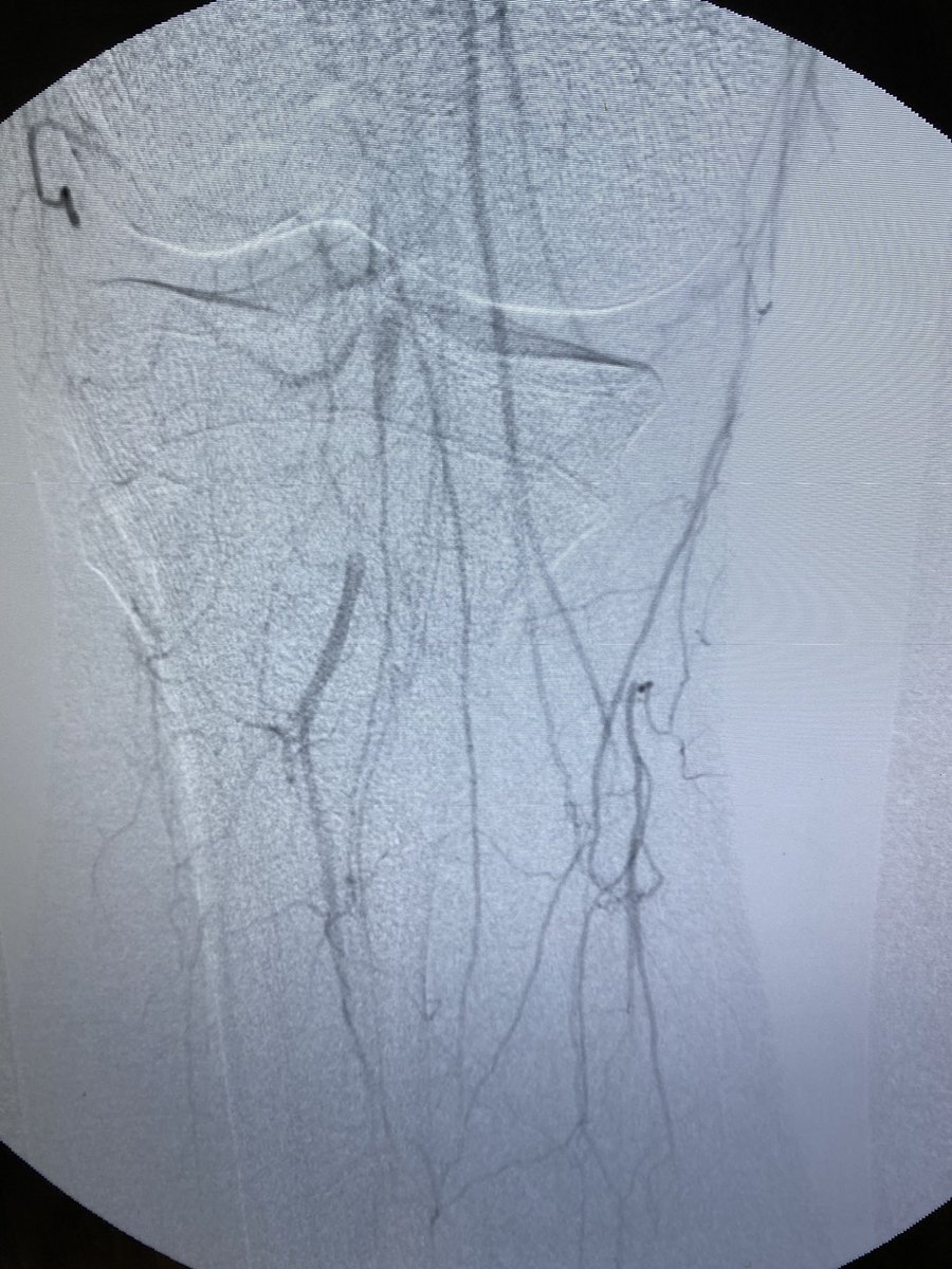 Revascularize's tweet photo. @CLI_Global @SIRspecialists @OEISociety @JRUNMD @bretwiechmann @FadiSaab17 @farkomd @vascularIR @monteromiguel @AnahitaDua @kmadass @SDhandMD https://t.co/MwCJFLpRYM