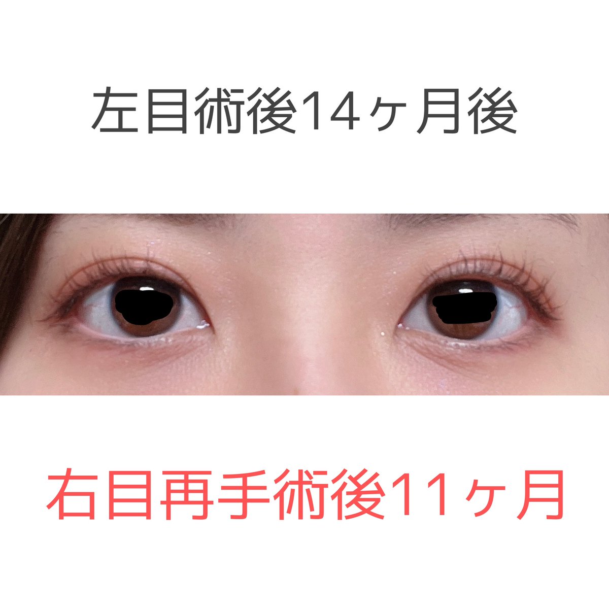 snowsmile412's tweet photo. DT左14m、右11m。
明けましておめでとうございます。久々に経過の画像と動画です。
右目も後少しで1年！
#眼瞼下垂 #保険適用 #二重切開 #ダウンタイム #DT https://t.co/gmmahyS2aX