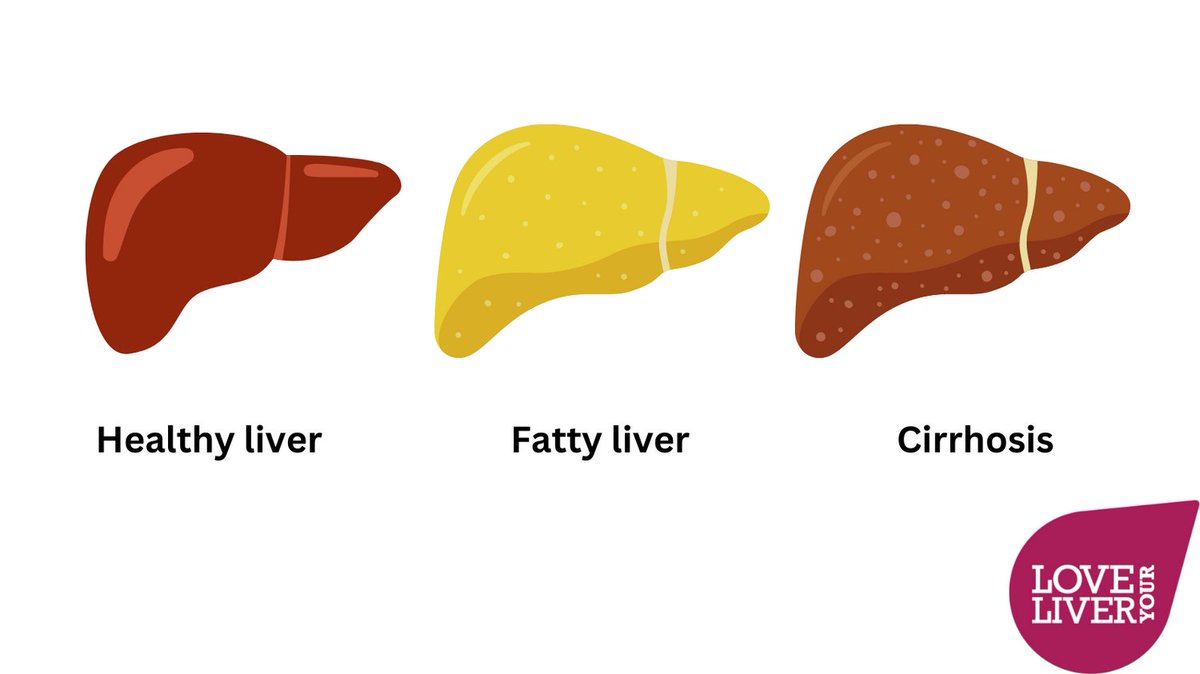 Fatty liver disease (#NAFLD) is caused by a build-up of fat in the liver. NAFLD usually affects people who are overweight.

NAFLD can lead to serious liver damage, including cirrhosis, if it gets worse. 

Prevent + improve #liverdisease w/ #healthyeating