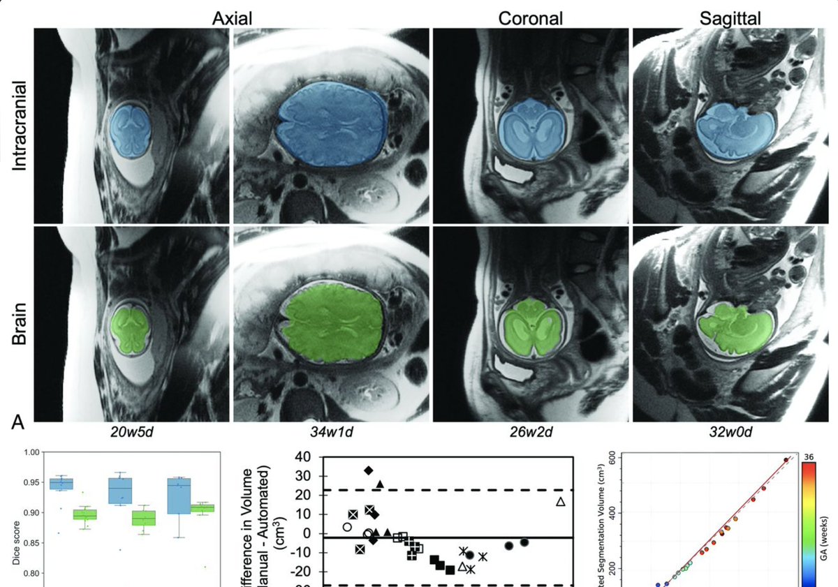 One step closer to rigorous reproducible norm-based analysis of brains, this time for fetal brain MRI -- great work by Carol Tran and Pierre Nedelec! #AI4babies ajnr.org/content/early/…
