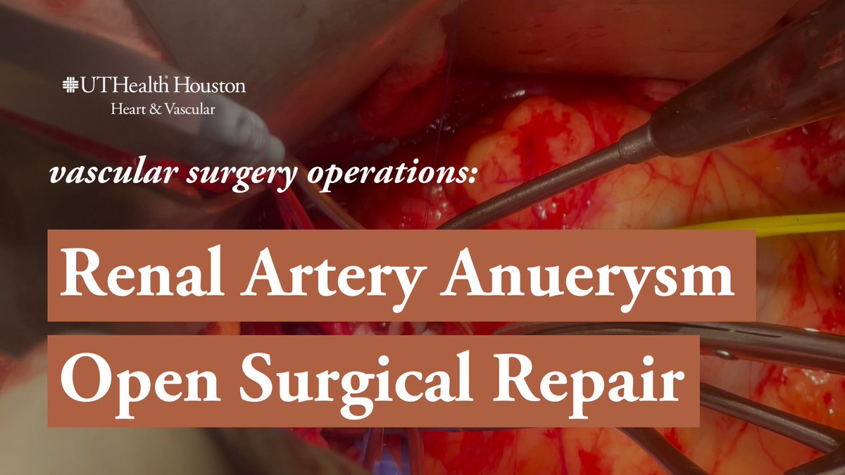 Mohammed I. Dairywala, MD (@midairywala) on Twitter photo 🪢 Renal Artery Aneurysm - Open Repair
Happy to share that our first video is live! Thanks to my mentor <a href="/NaveedSaqibMD/">Naveed Saqib</a>. Inspired by my time learning from <a href="/DeBakeyCVedu/">DeBakey CV Education - World Class CV Training</a> <a href="/AlanLumsdenMD/">Alan Lumsden, MD, CV Chairman/Director</a>
Check it out on the <a href="/UTHeartVascular/">UTHealth Houston Heart & Vascular</a> YouTube channel youtu.be/GTm553zIPDQ
<a href="/FutureVascSurgn/">FutureVascSurgeons</a> 🪢 Renal Artery Aneurysm - Open Repair
Happy to share that our first video is live! Thanks to my mentor <a href="/NaveedSaqibMD/">Naveed Saqib</a>. Inspired by my time learning from <a href="/DeBakeyCVedu/">DeBakey CV Education - World Class CV Training</a> <a href="/AlanLumsdenMD/">Alan Lumsden, MD, CV Chairman/Director</a>
Check it out on the <a href="/UTHeartVascular/">UTHealth Houston Heart & Vascular</a> YouTube channel youtu.be/GTm553zIPDQ
<a href="/FutureVascSurgn/">FutureVascSurgeons</a>