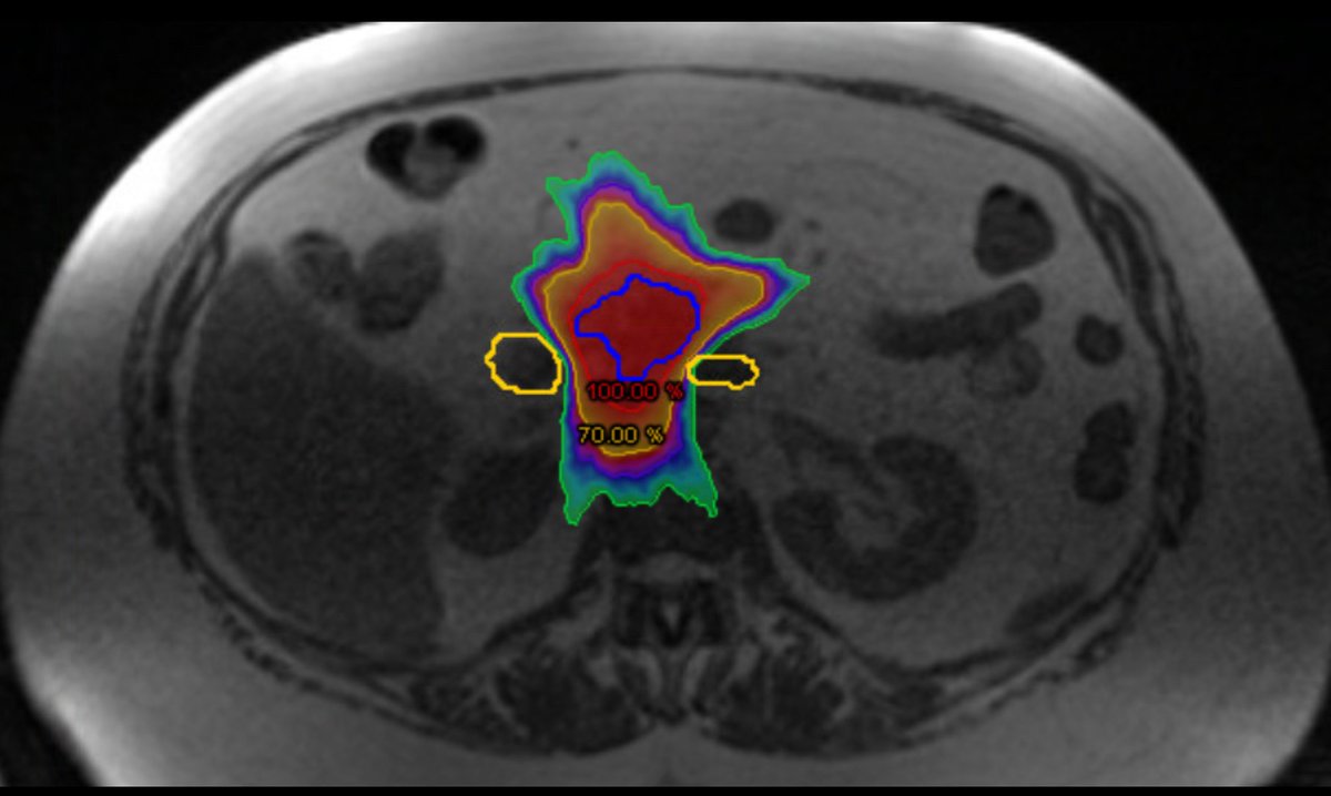 James Good (@drjamesgood) on Twitter photo How do we make real progress 🚀 in cancer medicine? Clinical trials. Doing them well, and implementing findings quickly. So today is a great💥 day, because we’ve treated two #NHS 🇬🇧 patients with #PancreaticCancer on study at <a href="/GenesisCare/">GenesisCareUK</a> in Oxford 🧵👇🏼 How do we make real progress 🚀 in cancer medicine? Clinical trials. Doing them well, and implementing findings quickly. So today is a great💥 day, because we’ve treated two #NHS 🇬🇧 patients with #PancreaticCancer on study at <a href="/GenesisCare/">GenesisCareUK</a> in Oxford 🧵👇🏼