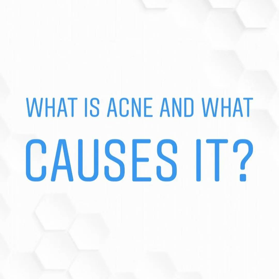 Who gets acne? #Acne can affect anyone, any #gender and any ethogenetic background. It is especially prevalent in #adolescents and #youngadults.  It can also occur in #children and #adults of all ages. #Skin #SkinHealth #Treatment #RightAdvice #Dermatologist