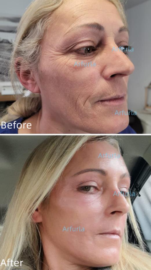 Jason_arfurla's tweet photo. Endolift skin rejuvenation, wrinkle removal results
#vaserliposuction #Vaserlipo #lipovaser #endolifting #endoliftlaser #lipolysis #laserlipolysis #lipolaser #laserlipo
#laserliposuction #980laser #1470laser #arfurla #fatremoval #fatburning #fatreduction #bodyslimming https://t.co/vu8wArOaoB