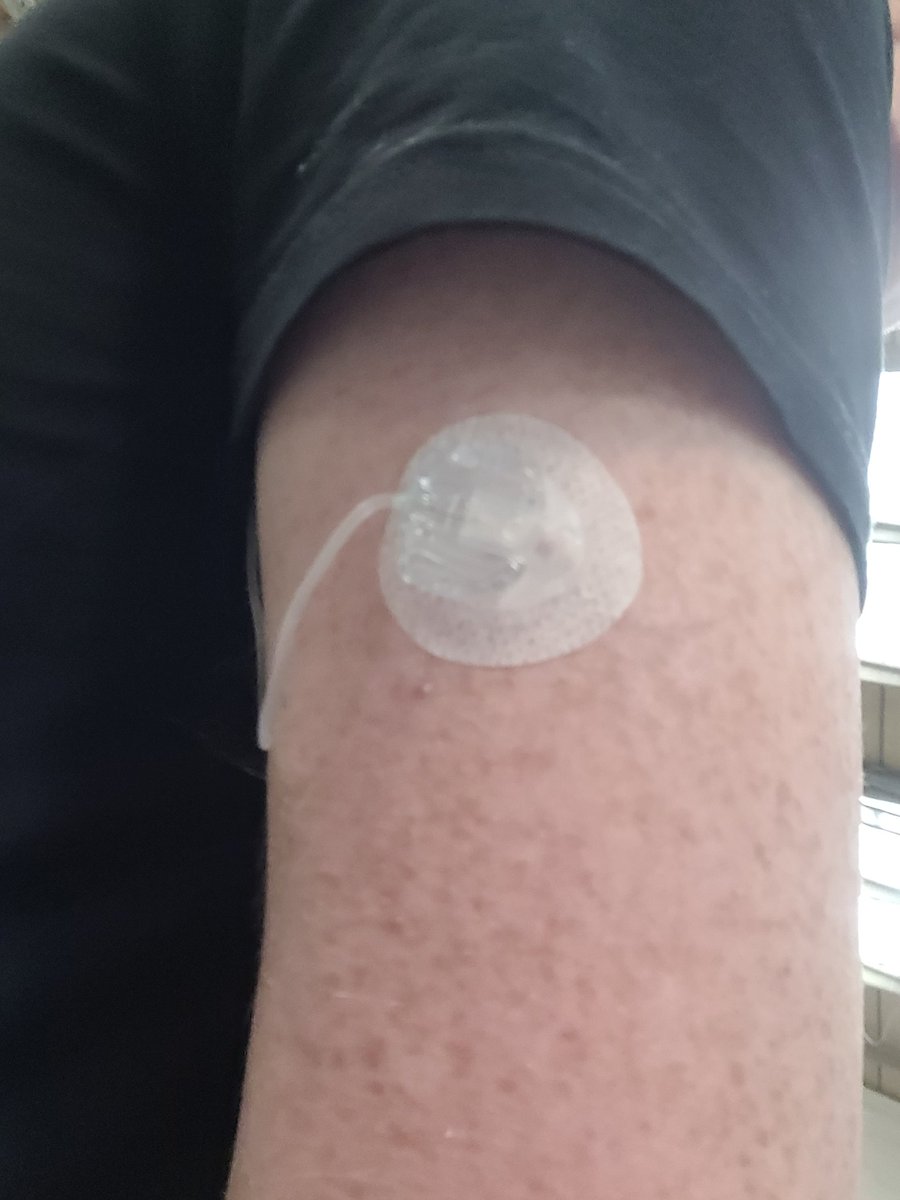 JustSteveOw3n's tweet image. Trying a new location for the #tslimx2 cannula 😬