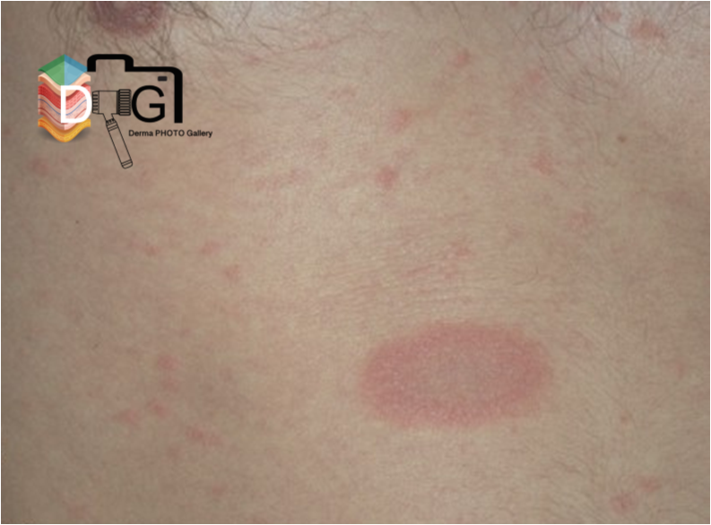 PITIRIASIS ROSADA DE GIBERT. VI. 1/2
DERMATOPATOLOGIA
No datos patognomónicos
Epiderm: paraqueratosis, acantosis, espongiosis, vesiculación intersticial con exocitosis linfocitaria
Derm: edema papilar, vasodilatación e infiltrados linfohistiocitarios y eosinofílicos perivascular