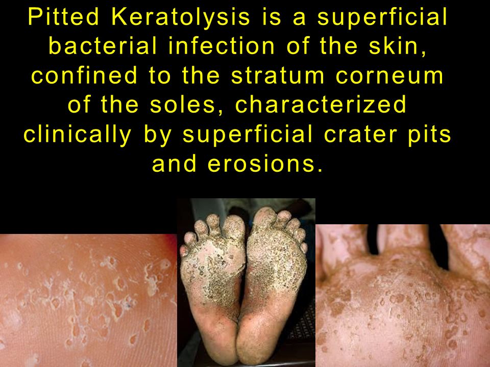 Pitted Keratolysis Hands