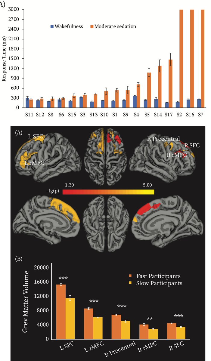 📢Ever worry about #accidental #awareness under #anaesthesia? New @NaciLabTCD 📜 relates thwarting of #PropofolSedation to inherent differences in #frontoparietal networks in 30% of people. @WileyNeuro @FengDeng93 @Comadork @rhodricusack doi.org/10.1002/hbm.26… @TCINeuroscience