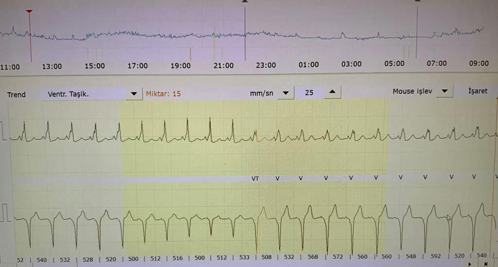 Kamil Gülşen (@kamilgulsen) on Twitter photo Opinions on what’s happening during holter monitoring <a href="/drserdardemir/">Doç Dr Serdar Demir</a> <a href="/ggdemir34/">Gültekin Günhan Demir</a> <a href="/ayhankup/">ayhankup</a> <a href="/drabdlkdruslu/">Abdulkadir Uslu</a> <a href="/can_yontar/">𝐂𝐚𝐧 𝐘𝐨𝐧𝐭𝐚𝐫</a> <a href="/HappyEP/">Emin Evren Özcan</a> <a href="/AslangerE/">Emre Aslanger</a> <a href="/taylanakgun/">Taylan Akgün</a> <a href="/SchakrabartiEP/">Shanta Chakrabarti</a> #Epeeps #ECG Opinions on what’s happening during holter monitoring <a href="/drserdardemir/">Doç Dr Serdar Demir</a> <a href="/ggdemir34/">Gültekin Günhan Demir</a> <a href="/ayhankup/">ayhankup</a> <a href="/drabdlkdruslu/">Abdulkadir Uslu</a> <a href="/can_yontar/">𝐂𝐚𝐧 𝐘𝐨𝐧𝐭𝐚𝐫</a> <a href="/HappyEP/">Emin Evren Özcan</a> <a href="/AslangerE/">Emre Aslanger</a> <a href="/taylanakgun/">Taylan Akgün</a> <a href="/SchakrabartiEP/">Shanta Chakrabarti</a> #Epeeps #ECG