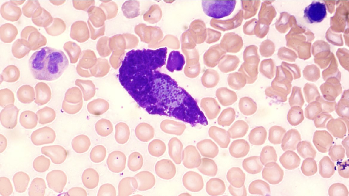 Kclarke864's tweet photo. Bone marrow from a 50y/o female with confirmed cutaneous mastocytosis and MCT of >70ug/L for >3 months ?systemic mastocytosis #haematology #hemepath #haempath #morphology #pathtwitter https://t.co/fvOcJD3U7M