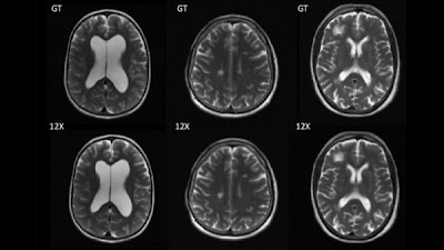 Radiology_AI's tweet photo. #DeepLearning accelerated reconstruction of 2-D brain MR images 3 to 4 times faster https://t.co/suLntUhgZY @NYUImaging @aibe_fau @UniFAU #undersampling #AI #MachineLearning https://t.co/kqA4XaiPFL