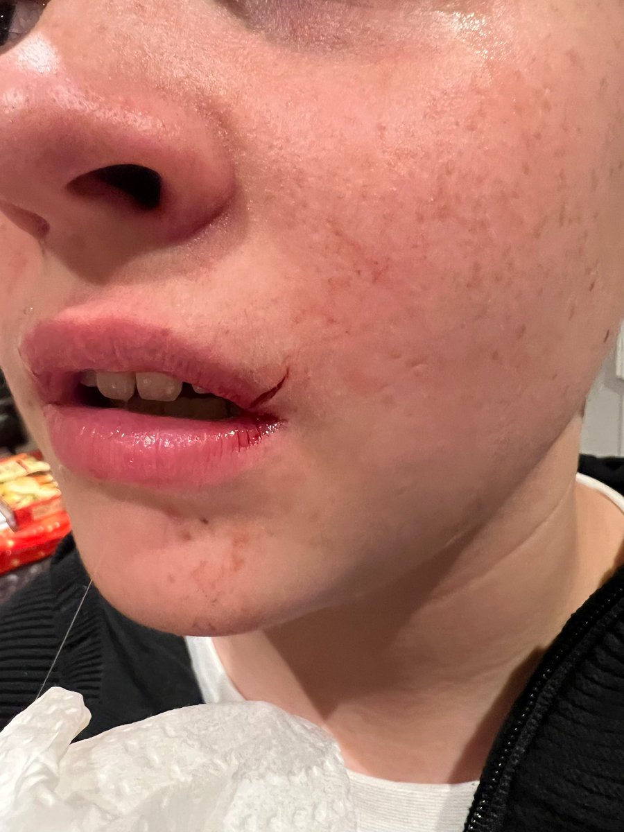 AlteredCha0s's tweet photo. @AldiUK we purchased some drinking glasses from you just before Christmas and on Saturday night this happened. My 13 year old son took a sip of his drink and the glass just disintegrated causing a cut lip and a trip to A+E. On inspection the quality is really poor! https://t.co/scXKEhSZOW