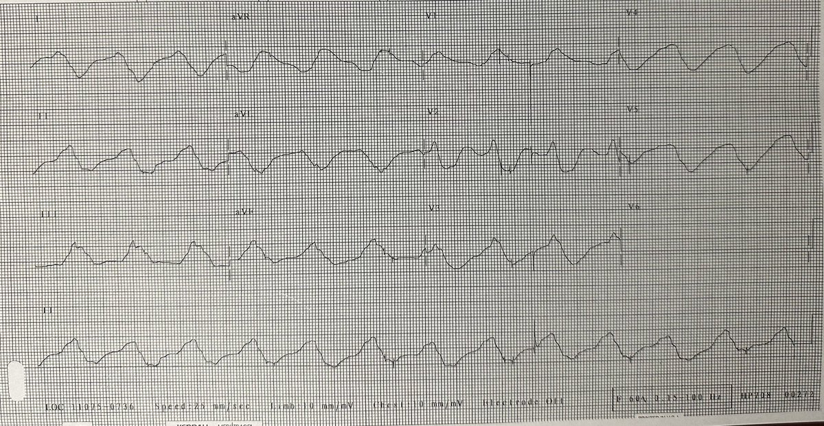 SShadman1's tweet photo. Question for fellows and residents-
56yo man, unknown medical history, transfer from outside hospital with no data except for this ECG. What to do next? #EPCardiology
#CardioTwitter #FITacc https://t.co/3PN1G1RPHS