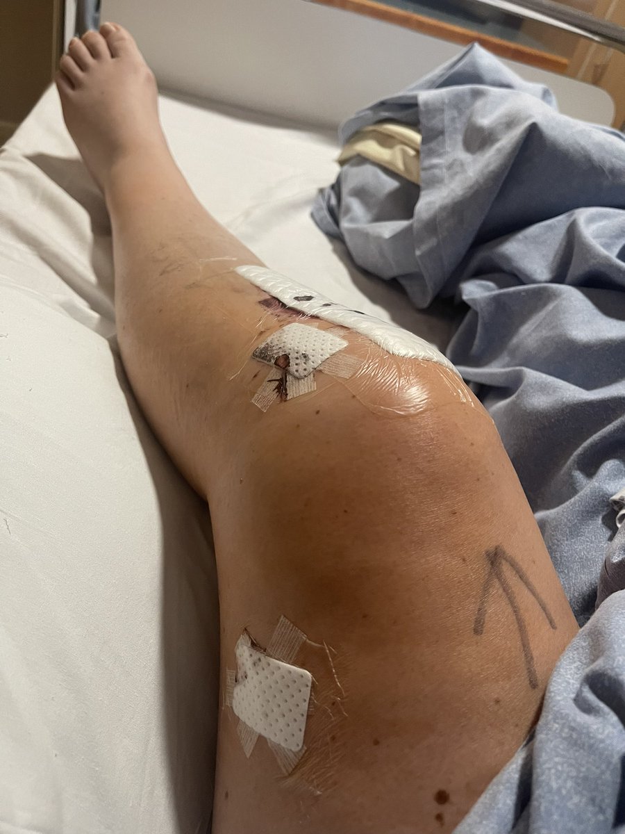 JockeyRach's tweet photo. After 16months physio and 3 operations on my knee,today my physio said I may actually be heading in the right direction and he’s starting to notice improvements! 

Finally 🥳🎉

#tornacl
#dislocatedknee
#tornmeniscus
#fracturedtib https://t.co/6gDNWvnKza