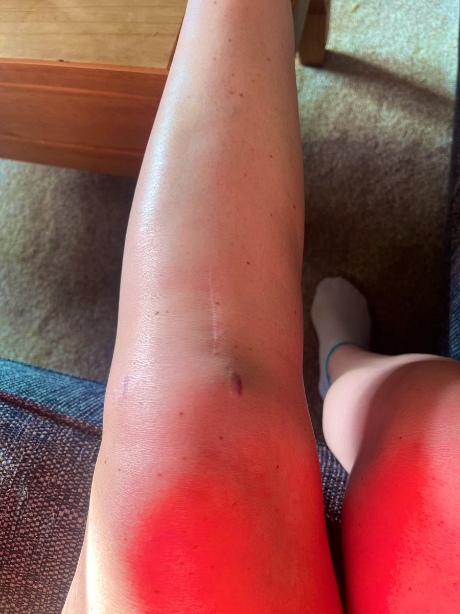 JockeyRach's tweet photo. After 16months physio and 3 operations on my knee,today my physio said I may actually be heading in the right direction and he’s starting to notice improvements! 

Finally 🥳🎉

#tornacl
#dislocatedknee
#tornmeniscus
#fracturedtib https://t.co/6gDNWvnKza