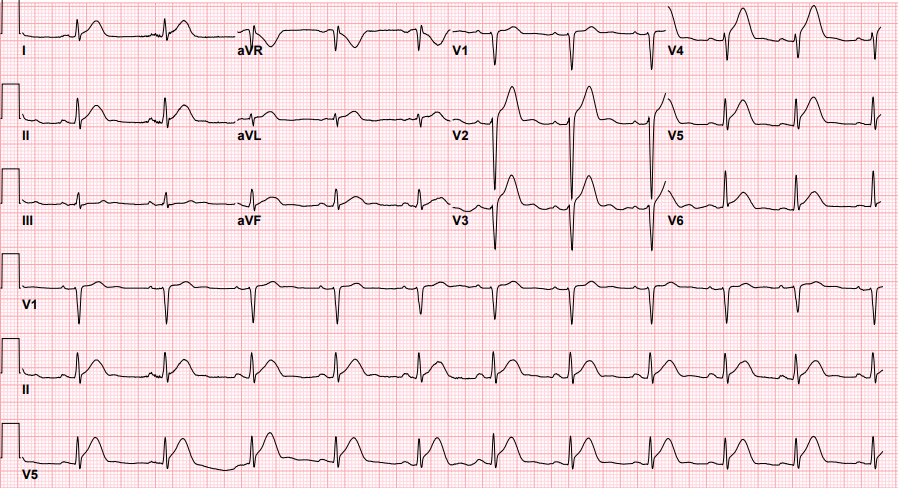 A teenager with chest pain, a troponin below the limit of detection, and "benign early repolarization"

hqmeded-ecg.blogspot.com/2023/01/a-teen…
