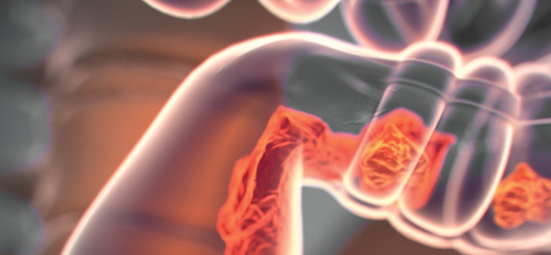 MedTechNow_'s tweet image. #clinicaltrials

~@Neuralace enrolls1st patient in study evaluating  painful #DiabeticNeuropathy treatment 

~Patient in #SynerFuse&apos;s #SpinalFusion &amp;amp; DRG #neuromodulation proof-of-concept study

~@DiaCarta_DX successfully completes Oncuria® validation study with @Nonagen_T