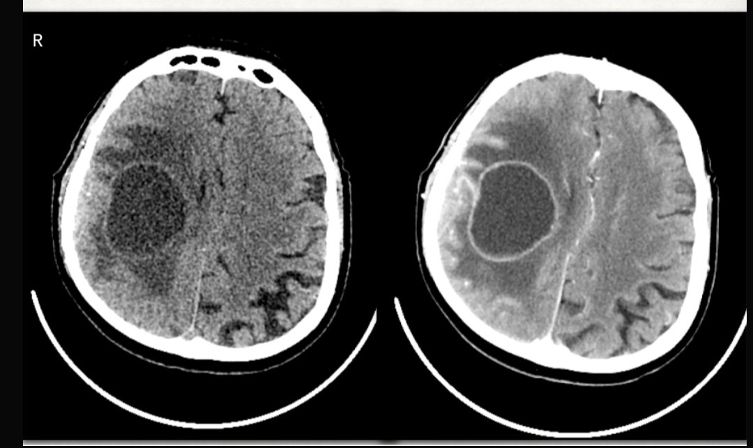 sthanu-on-twitter-patient-60-yo-presents-in-er-for-onset-of-stroke