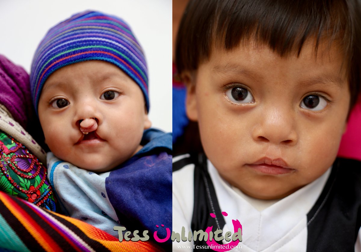 TessUnlimited's tweet photo. We hope everybody had some great holidays together!
#Welcome2023! Today we started our #FirstDayAtTheOffice.
We are excited to kick-off a amazing year once more!
#changinglives of #Children born with #cleftlipandpalate right here in #Guatemala.
#tessunlimited https://t.co/O19zQvWaSN