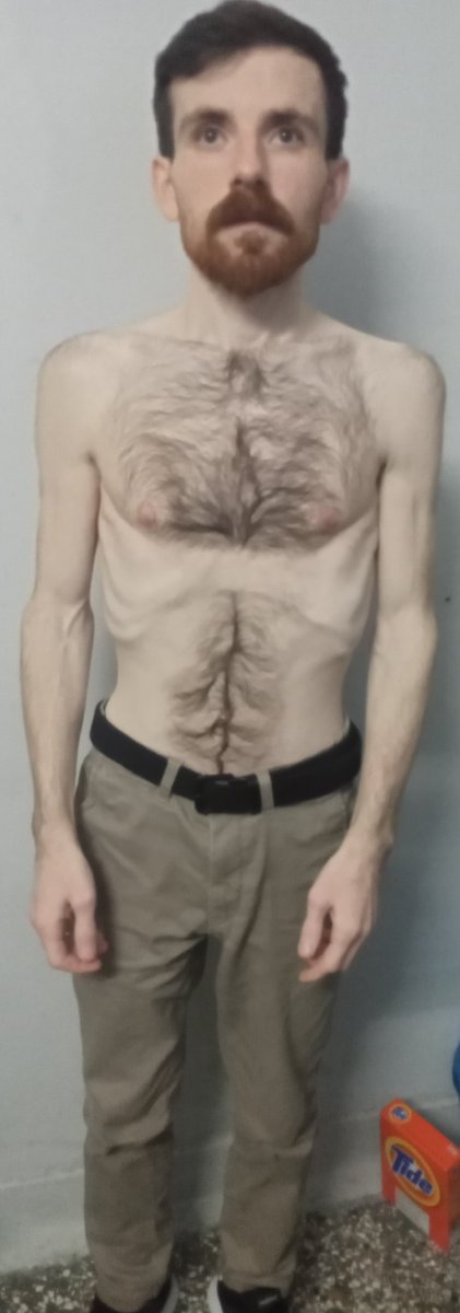 aiftv1's tweet photo. Burak Ağarmış, one of the 11 revolutionary prisoners from Turkey in Greek prisons, has been weighed 45.50 kg during the medical examination held on the 95th day (9 January 2023) of his indefinite hunger strike for a fair trial.
#freethe11
#antireport https://t.co/WJ1NdPBuSM