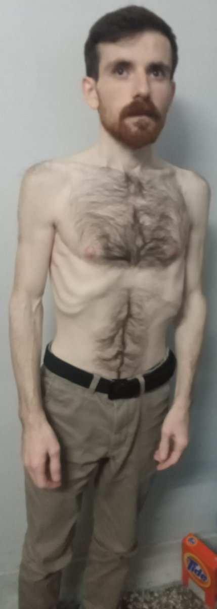 aiftv1's tweet photo. Burak Ağarmış, one of the 11 revolutionary prisoners from Turkey in Greek prisons, has been weighed 45.50 kg during the medical examination held on the 95th day (9 January 2023) of his indefinite hunger strike for a fair trial.
#freethe11
#antireport https://t.co/WJ1NdPBuSM